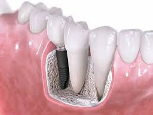 ایمپلنت دندانی Dental implant