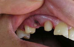 دندان کنده شده را دوباره بکارید