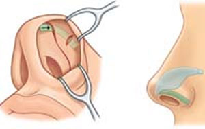 دو تکنیک موجود جهت انجام عمل جراحی زیبایی بینی