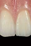 تحلیل تنش دندان های قدامی ماگزیلا به هنگام اعمال نیروی اینتروزیو بین لترال و کانین