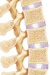 بررسی نتایج درمان غیرجراحی بیماری Scheuermann kyphosis در یک مطالعه هشت ساله