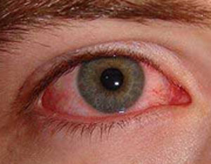 علت قرمزی چشم ها چیست