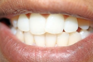 فرق پوسیدگی و تغییر رنگ دندان در چیست