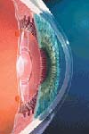مقایسه سرعت رشد بافت فیبرووسکولار در ایمپلنت های چشمی اولیه و ثانویه