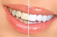 برای سفید کردن دندان هایتان, اصرار نکنید