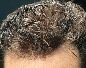 پیوند مو چیست