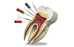 درمان ریشه یا کشیدن دندان