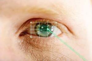 نسل چهارم لیزر برای تصحیح عیوب انكساری چشم