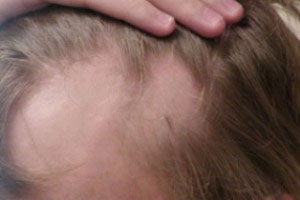 آیا کاشت مو در پوست آسیب دیده امکان پذیر است