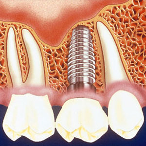 ایمپلنت در دنیای دندانپزشکی