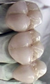 بررسی استحکام باند چینی دندانی اپک T۱۱۴ و دنتین D۴ جدید مورد استفاده در سیستم چینی فلز و مقایسه آن با چینی دندانی کارخانه ویتا