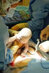 رابطه عوامل بدو تولد نوزادان زایمان طبیعی با بستری مجدد در بیمارستان