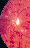 نوروتومی عصب بینایی از طریق ویترکتومی به عنوان گزینه درمانی جدید در انسداد سیاهرگ مرکزی شبکیه