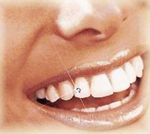 از نگین دندانی چه می دانی