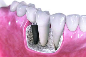 جایگزینی دندان با ایمپلنت