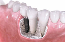 آنچه باید درباره کاشت دندان بدانید
