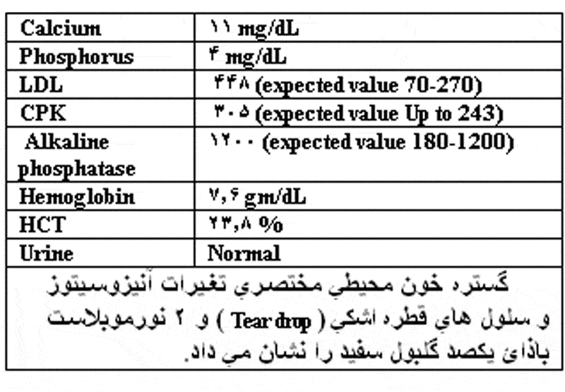 استئوپتروزیس نوزادی, گزارش مورد