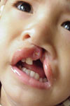 بررسی ناهنجاری قلبی در کودکان مبتلا به شکاف های دهانی در بیمارستان های دانشگاه های علوم پزشکی تهران