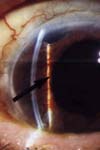 گلوکوم زاویه باز, گلوکوم مشکوک و هیپبتانسیون چشمی در اربیتوپاتی گریوز