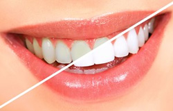 جرم گیری, بروساژ و سفید کردن دندان چه تفاوتی دارند
