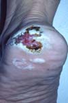 گزارش یک مورد آکرال لنتیجینوس ملانوما که به مدت ۱۶ ماه با تشخیص زخم مزمن درمان می شد