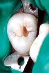 مقایسه ضخامت عاج باقیمانده در زیر پوسیدگی پروگزیمالی در رادیوگرافی Bitewing و نسج دندان