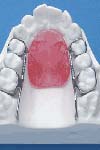 بررسی تنش ایجاد شده درPDL دندان های قدامی مگزیلا به هنگام اعمال نیروی اینتروزیو در دیستال دندان نیش