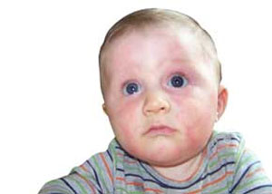 حساسیت های پوستی در کودکان