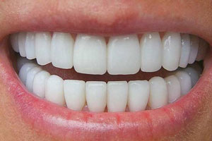 حفظ سلامت دندان ها با تغییر سبک زندگی