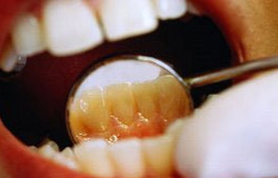 چگونه دندان های سفیدتر و درخشان تری داشته باشیم