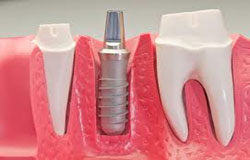 مدیریت درمان در کاشت دندان