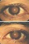 بررسی پتانسیل برانگیخته چشمی در بیماران مبتلا به نارسایی مزمن کلیه و افراد با سابقه پیوند کلیه