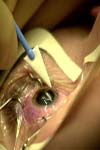 نقص بالا بردن یک چشم گزارشی از بیماران جراحی شده طی ۱۰ سال در بیمارستان لبافی نژاد