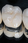 مقایسه استحکام خمشی پرسلن دندانی جدید D۴ Dentin با پرسلن دندانی کارخانه VMK ۶۸N Vita