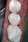 بررسی اثر نوع فیلر بر سایش سه جزیی کامپوزیت دندانی