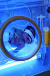 ارزیابی تاثیر اتاق آینه در کاهش هیپربیلی روبینمی نوزادی