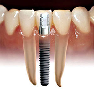 پیشگیری از تحلیل استخوان فک با کاشت دندان