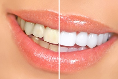 سفید کردن دندان هر چند وقت یک بار مجاز است؟