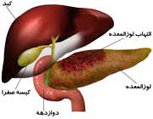 علایم سرطان لوزالمعده