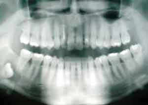 خطر رادیوگرافی دندان