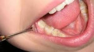 تأثیر شیمی‌درمانی بر دهان و دندان