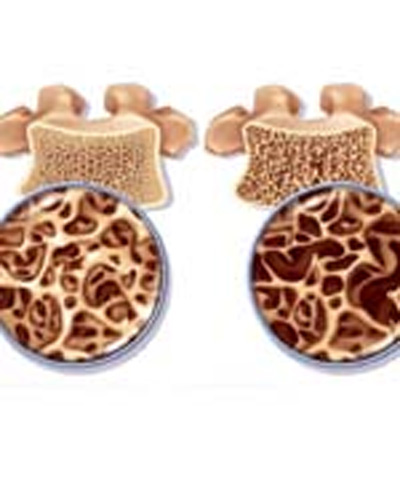 پوکی استخوان، مشکل مبتلایان به ضایعات نخاعی