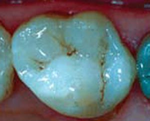 دندان‌های عقبی را هم می‌توان با مواد هم‌رنگ دندان ترمیم کرد