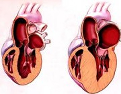 بزرگ شدن قلب؛ علل، علائم و درمان