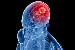 تومور مغزی چه نشانه هایی دارد؟