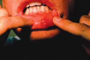 رابطه شیمی‌درمانی و زخم‌های دهانی