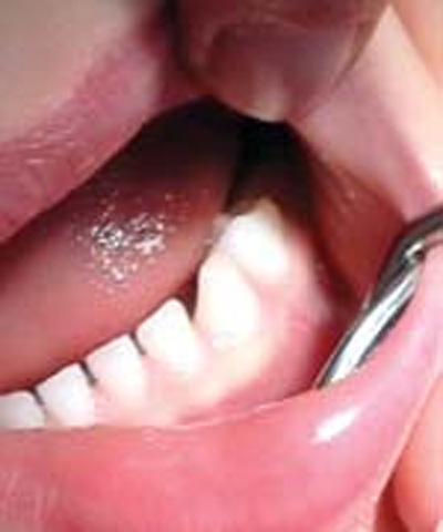 پیوره، عامل لق شدن و افتادن دندان ها