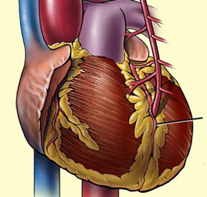 نارسایی قلبی در اثر چاقی شکمی