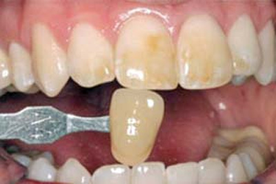 راهکارهایی برای رفع لکه های دندان