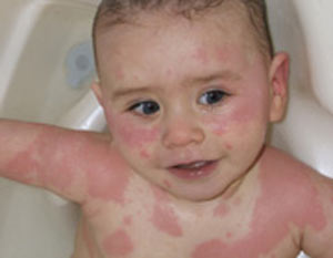 افزایش آمار آسم آلرژی در کودکان